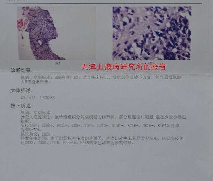 妹妹患淋巴<em>瘤</em>,请问这样的治疗方案可以吗?谢谢