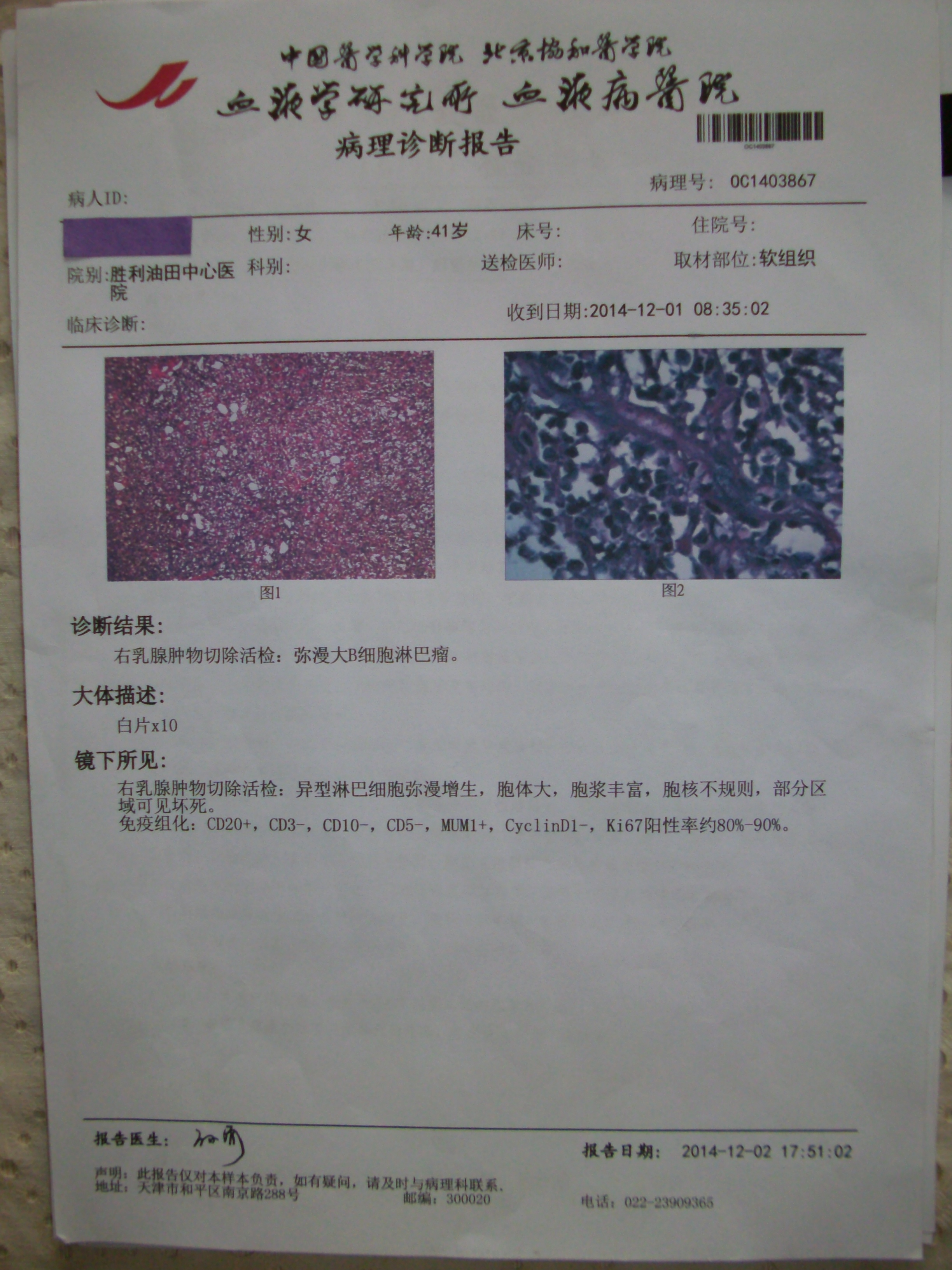 原发乳腺的弥漫大B淋巴瘤病理报告-淋巴瘤之家