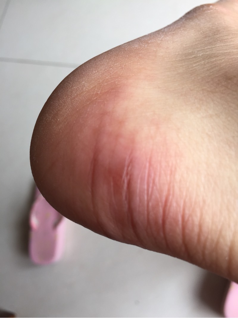 四疗后脚腕脚后跟有长冻疮一样的痛