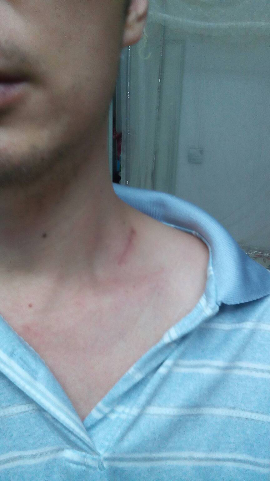 感觉右锁骨上的肿块大了