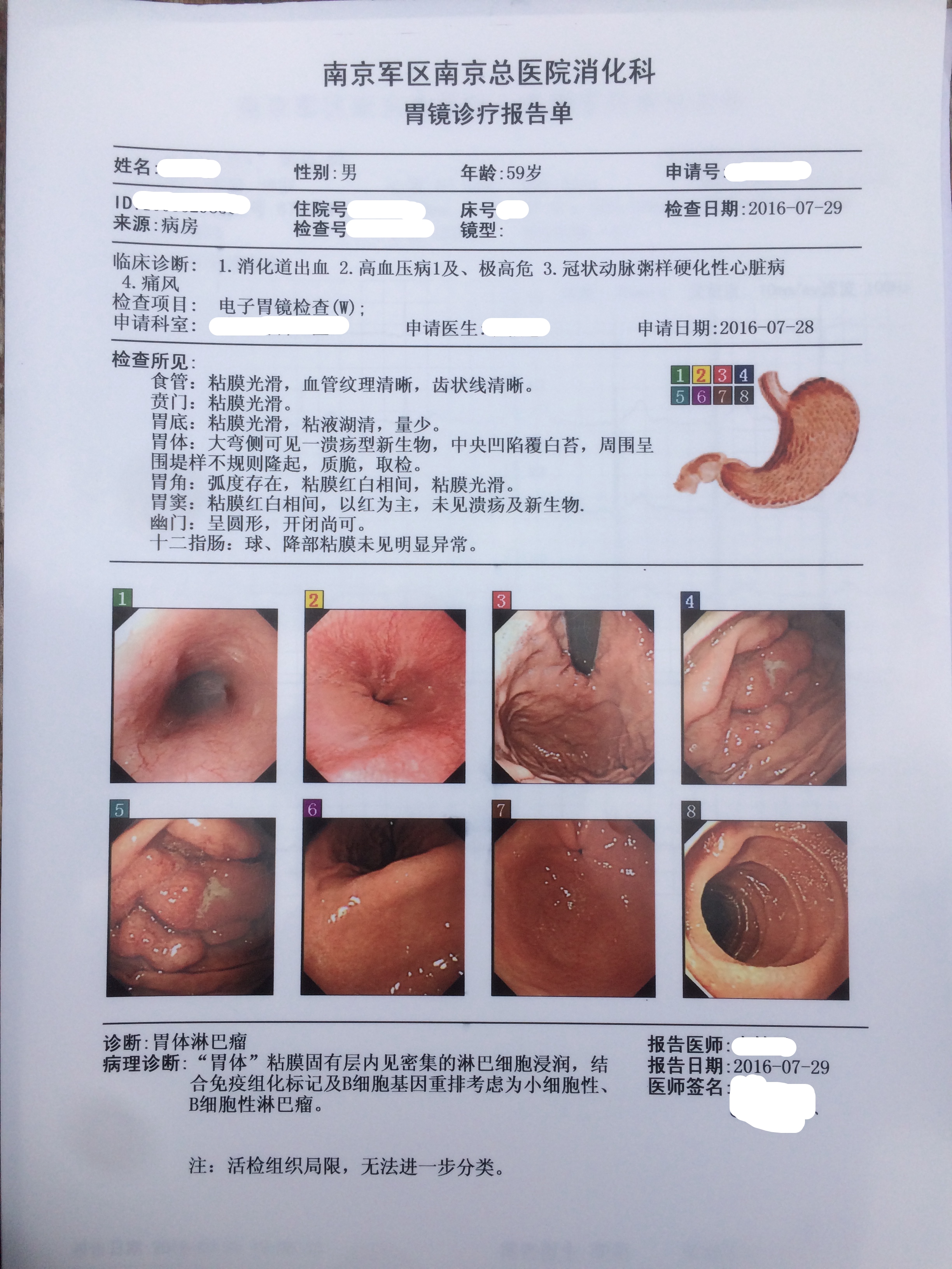 69 病友互助 69 解读报告 69 父亲胃出血,查出淋巴瘤.