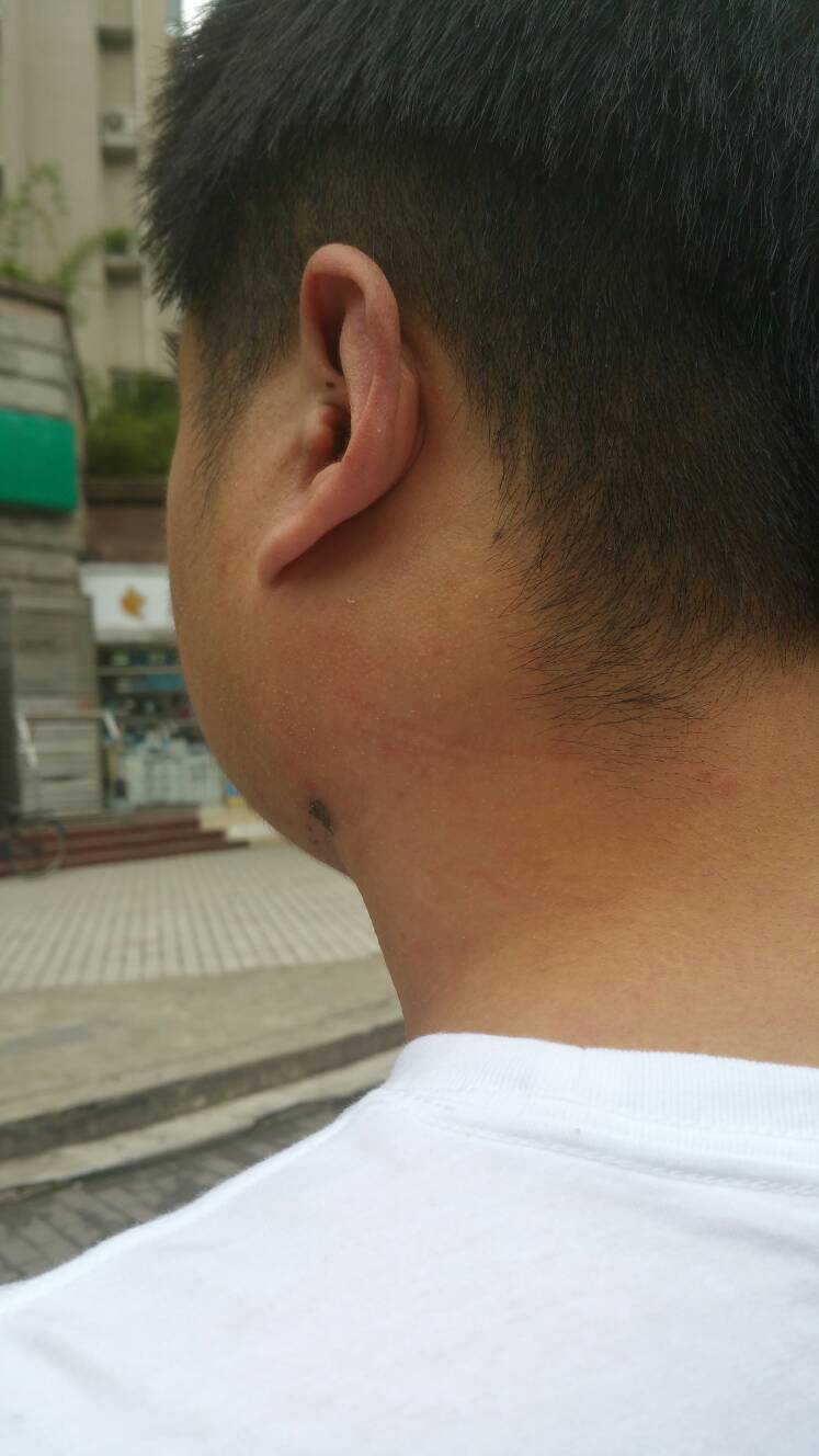 左侧耳朵边上肿肿成这样