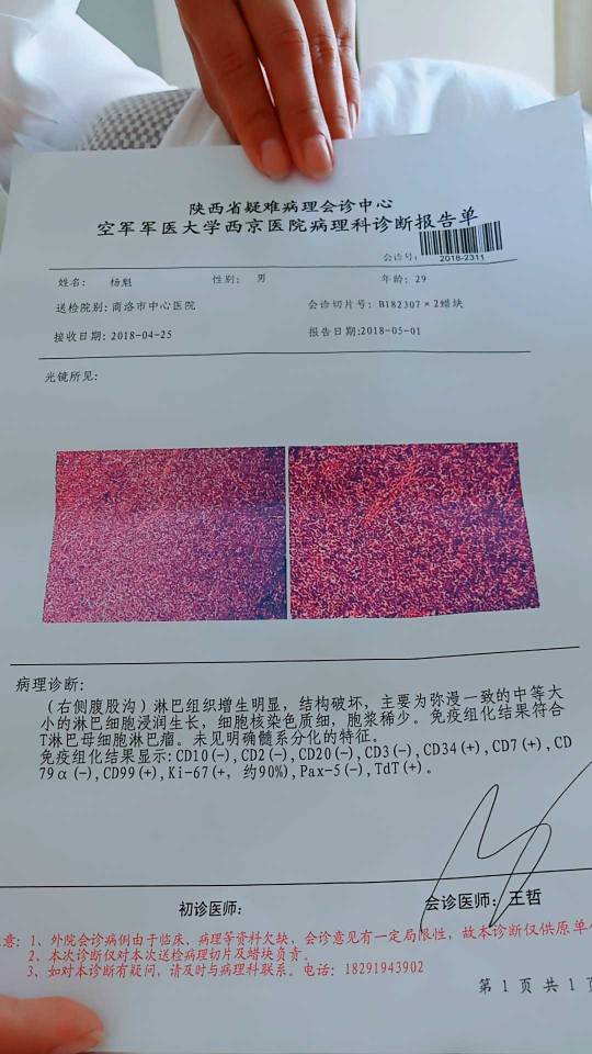 非霍奇金淋巴瘤t淋巴母细胞淋巴瘤白血病