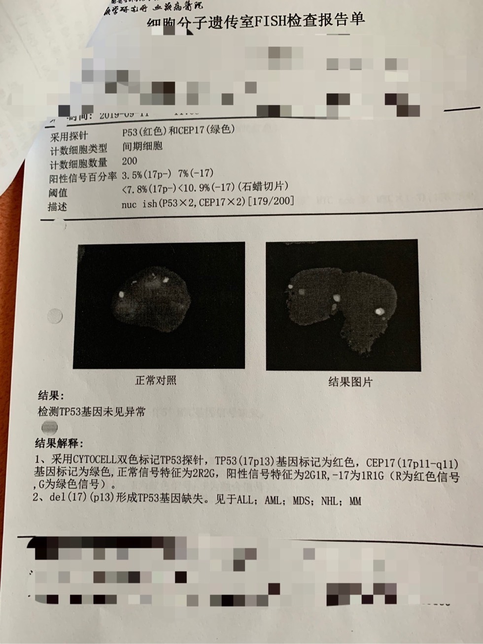 请帮忙看一下fish检测tp53基因未见异常基因突变检测是tp53突变这是