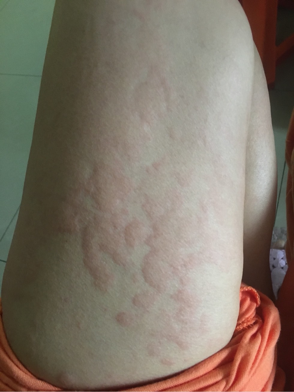 7/10号放疗第15次了,全身痒像过敏一样,好难过,有放疗的朋友出现这种