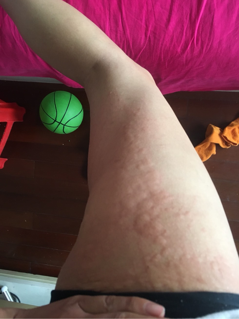 7/10号放疗第15次了,全身痒像过敏一样,好难过,有放疗的朋友出现这种