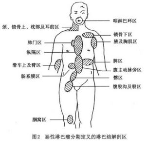 淋巴癌位置图图片