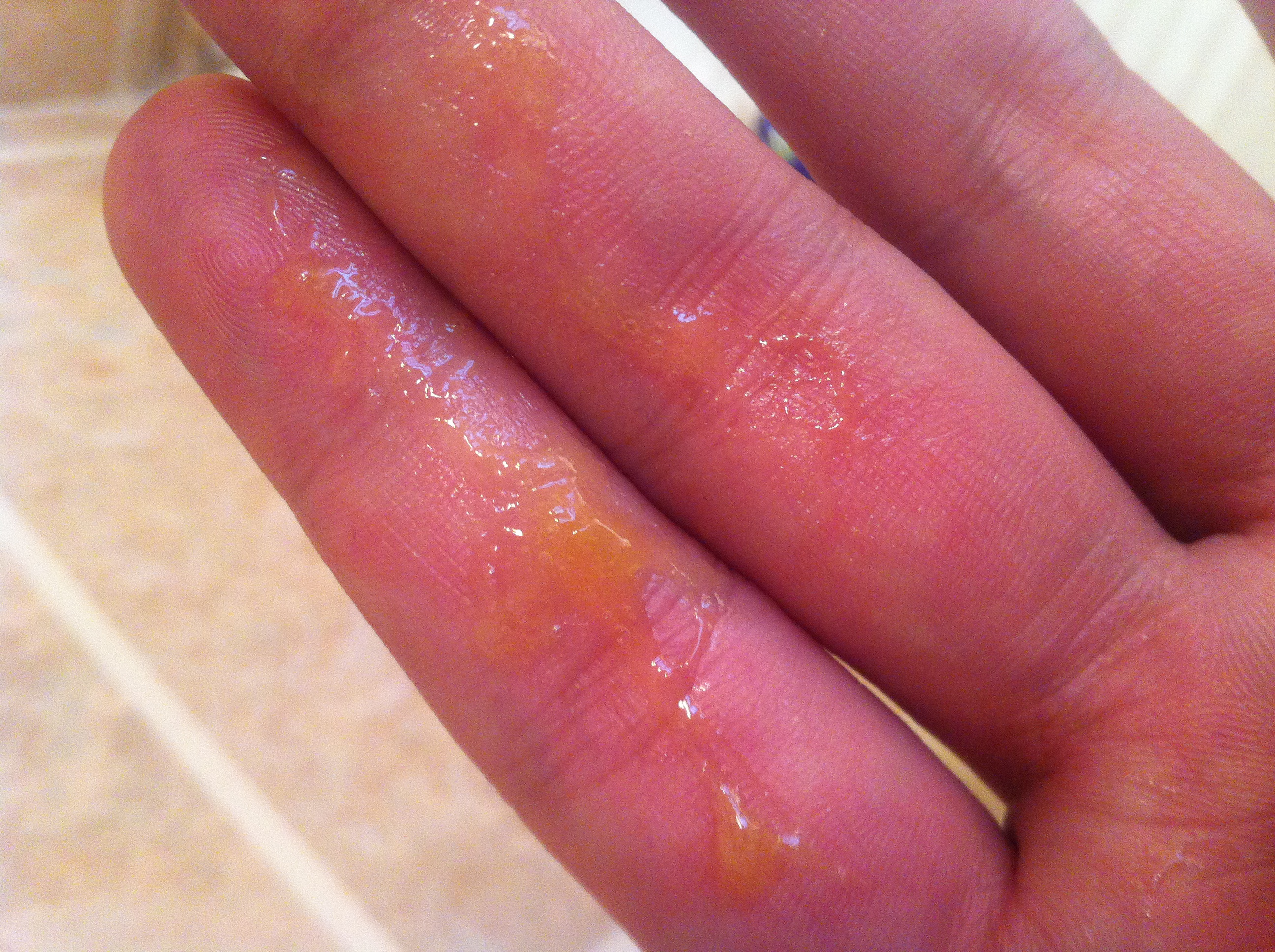 图为鼻腔内脓液