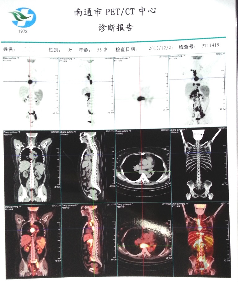 第一次PET报告