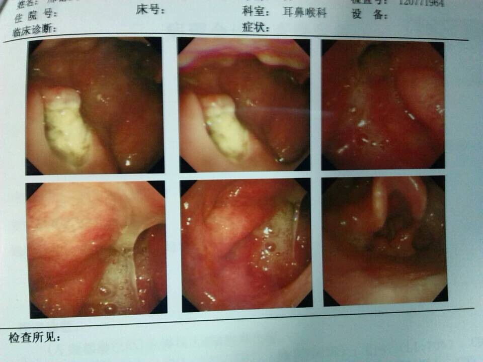 弥漫大b第一次化疗后,腹部隐痛