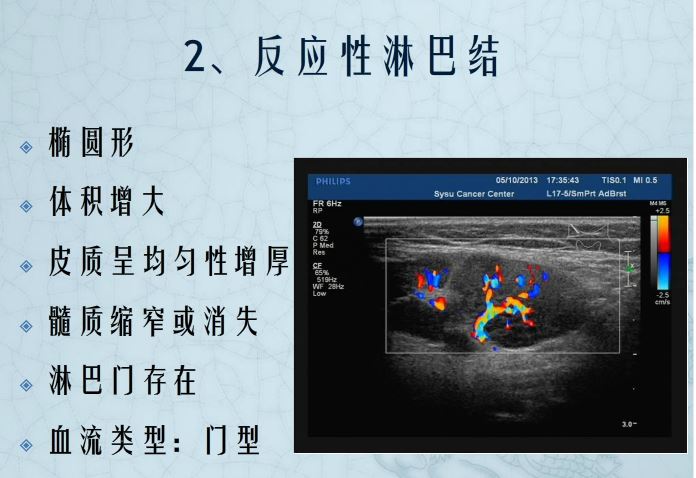 反应性增生淋巴结b超