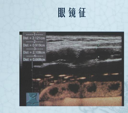 结核性淋巴结图像