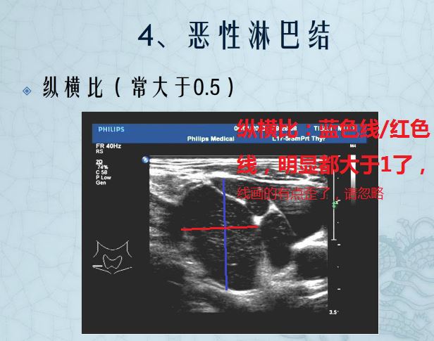 恶性淋瘤结纵横比