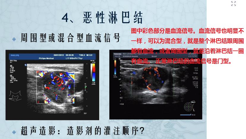 恶性淋巴瘤血流信号特点