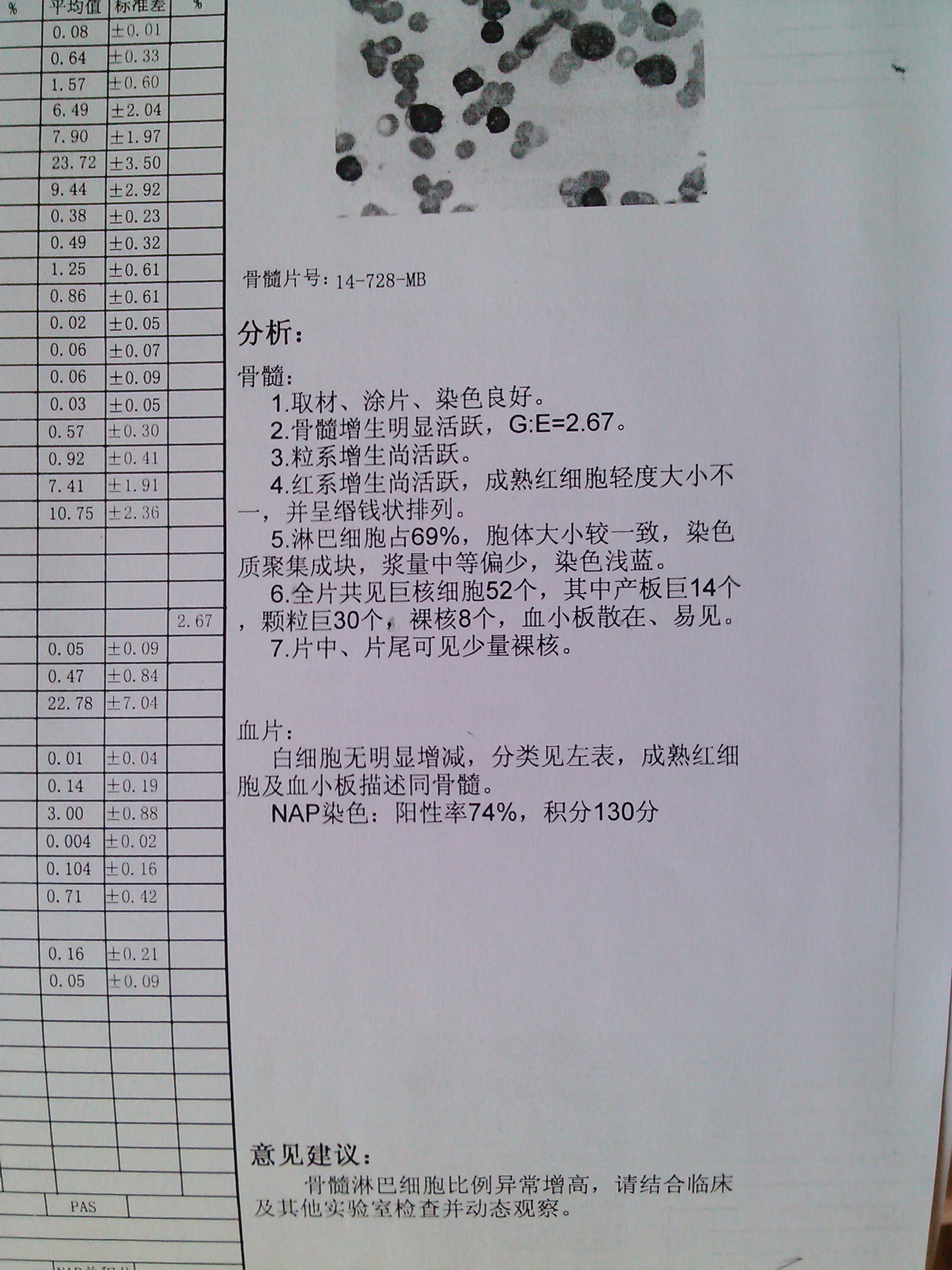 骨髓穿刺诊断6.jpg