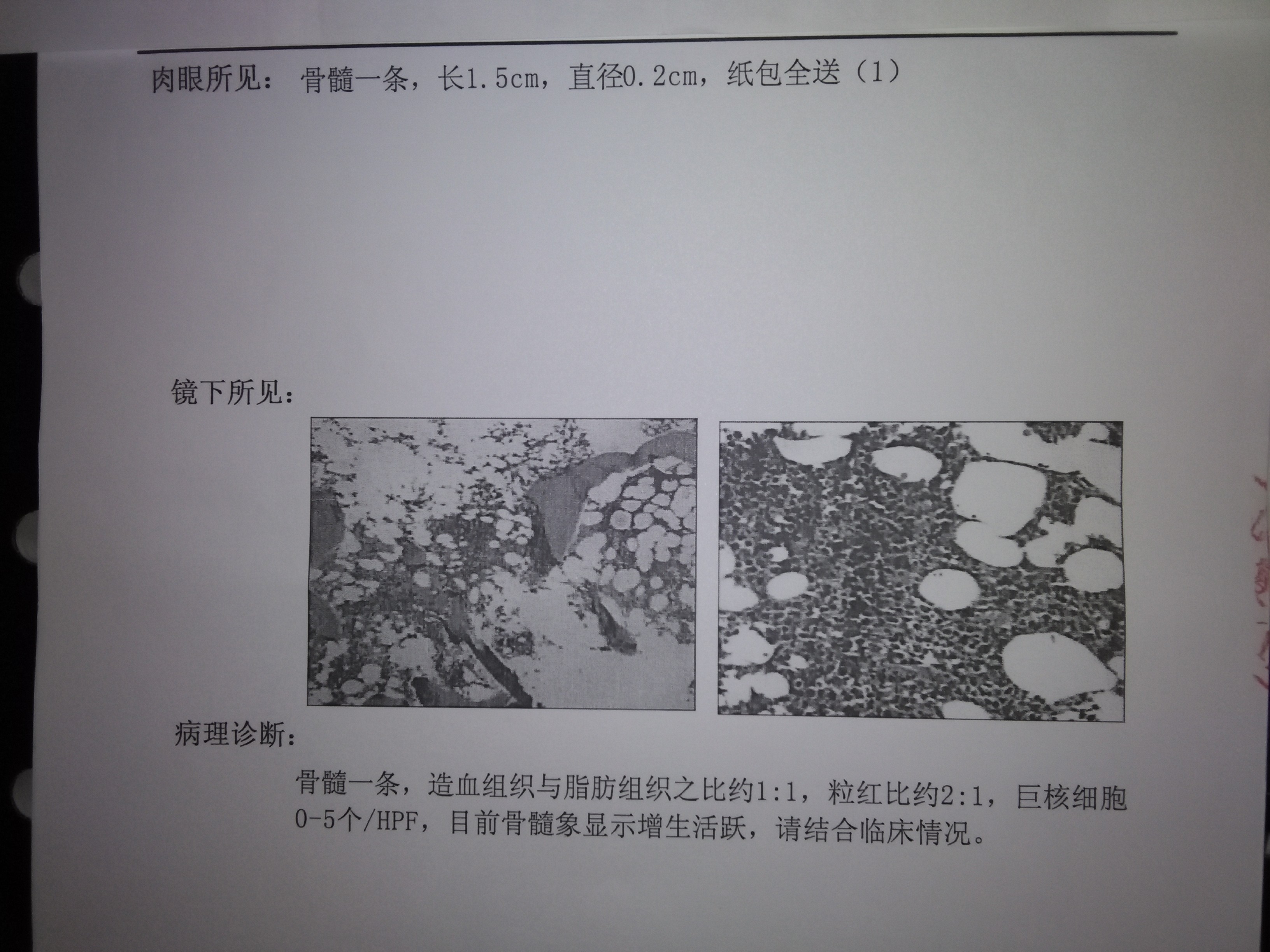 骨髓（骨客 骨）病理诊断报告单