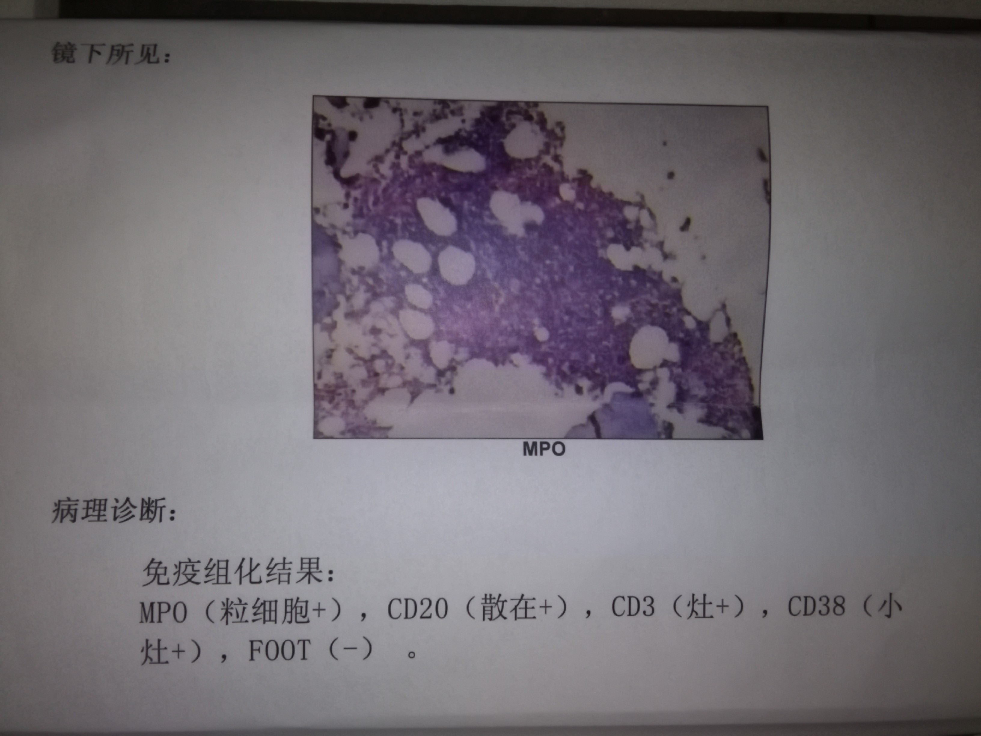 骨髓病理免疫组化报告单