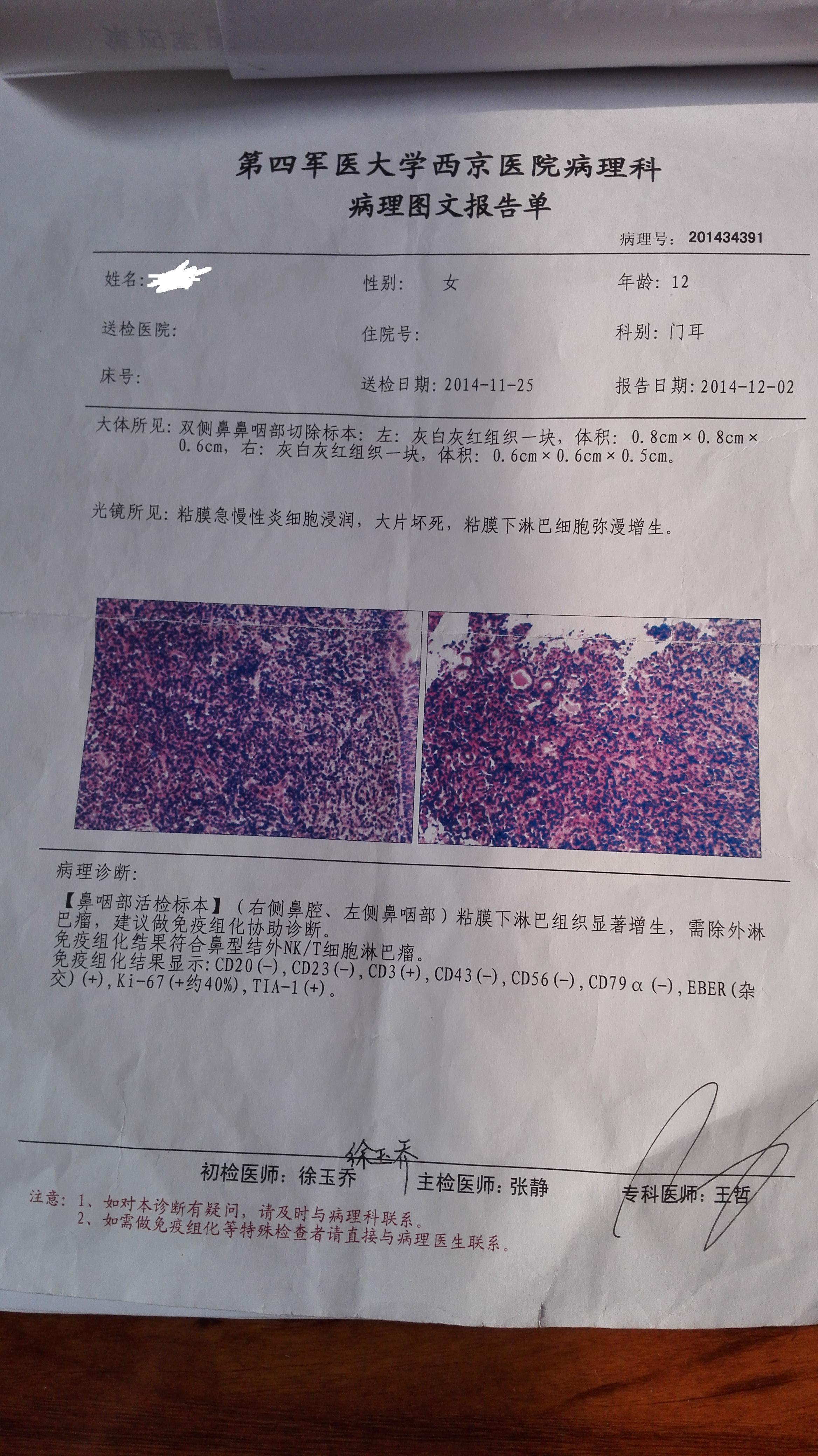 (二)淋巴上皮瘤样癌(lymphoepitheliomalike carcinoma,LELC)