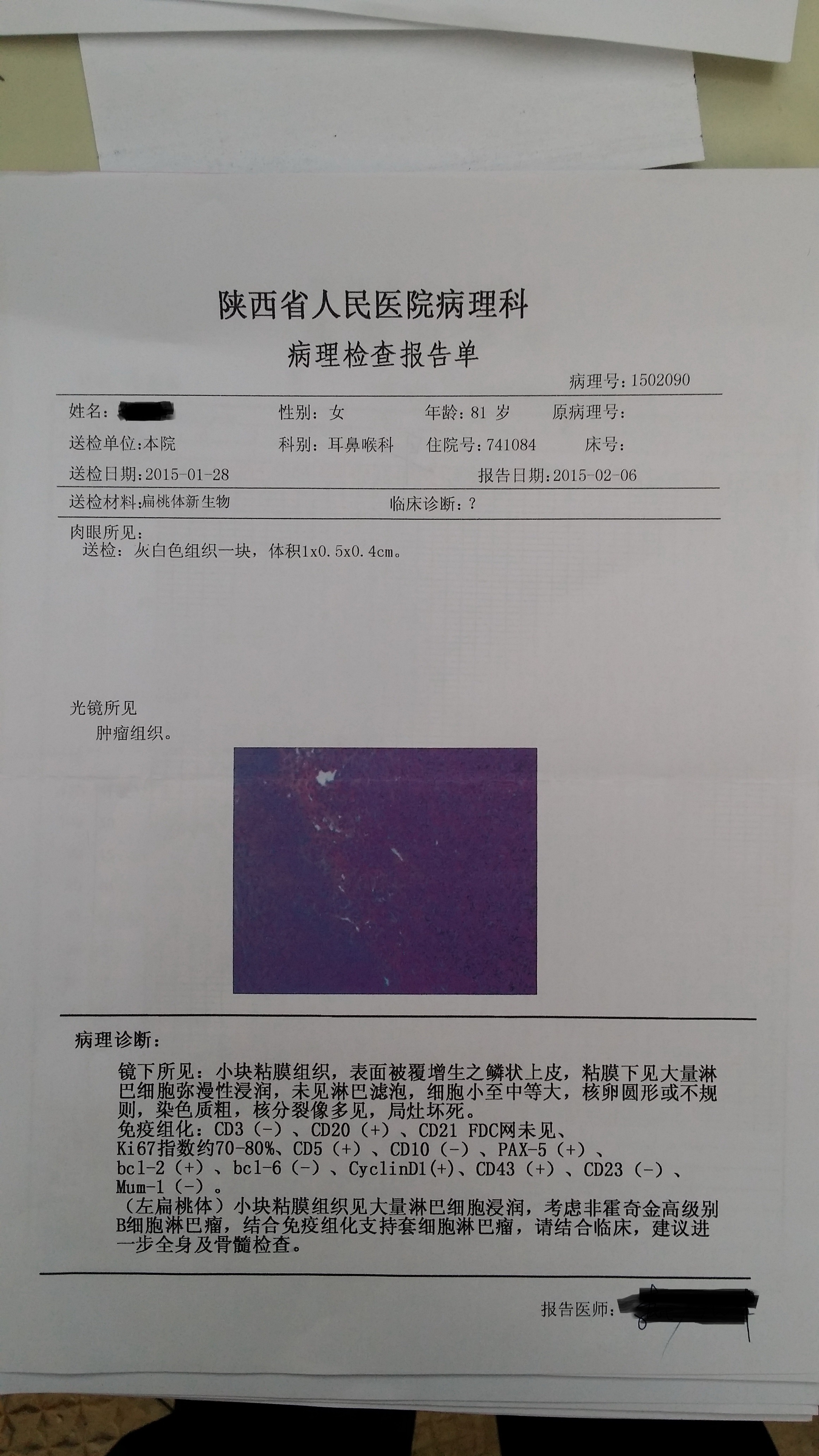 扁桃体上肿物的病理检查报告