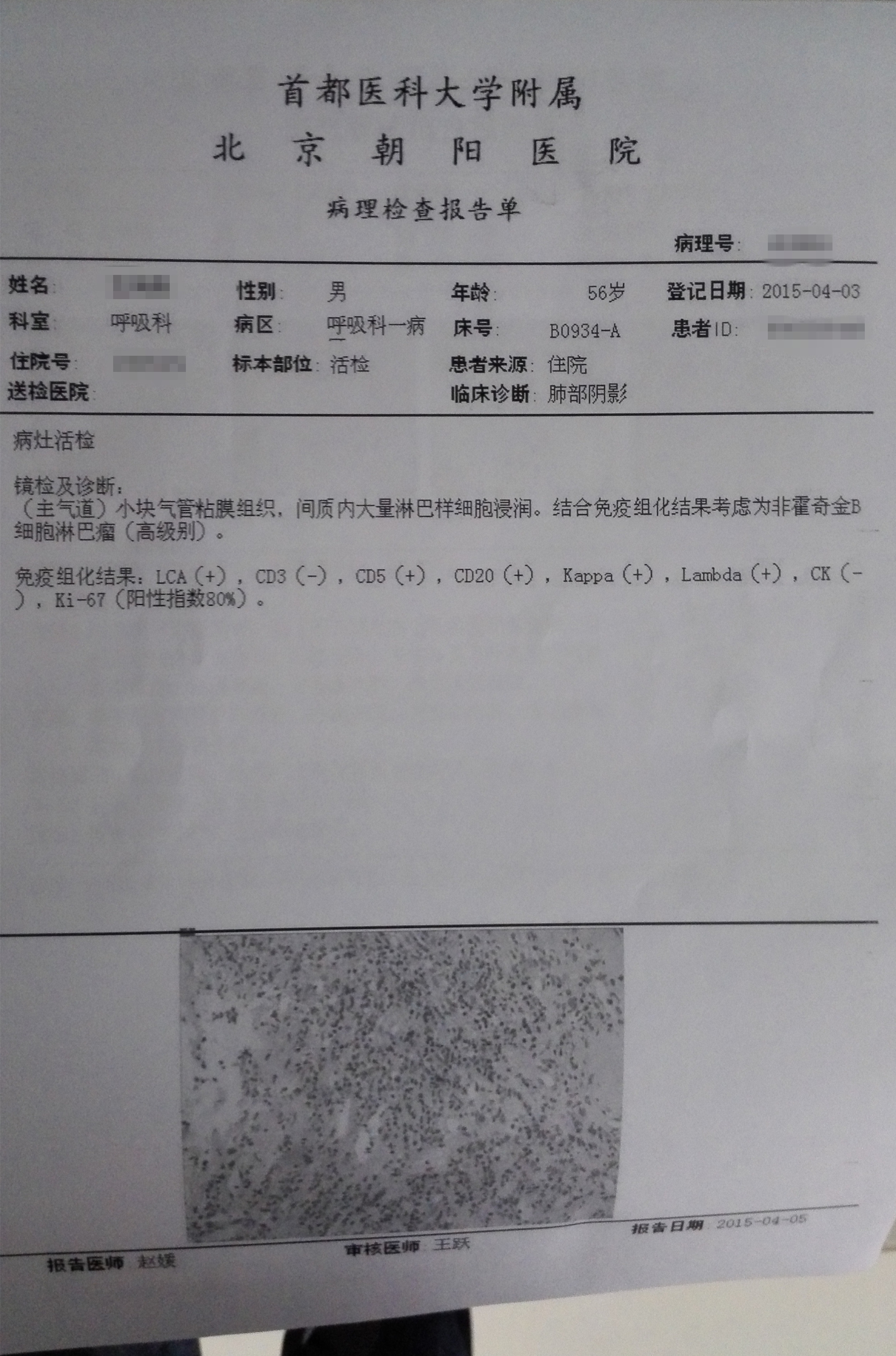 非霍奇金淋巴瘤.jpg