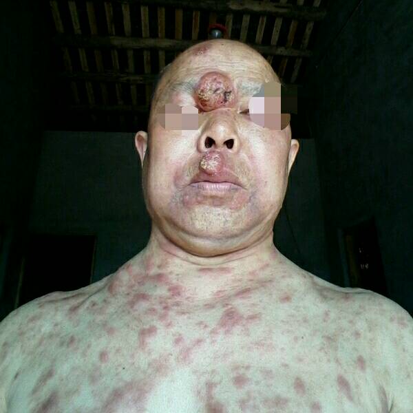 化疗是这样的,你看看我亲属,外周t细胞淋巴瘤,非特指,现在六次化疗