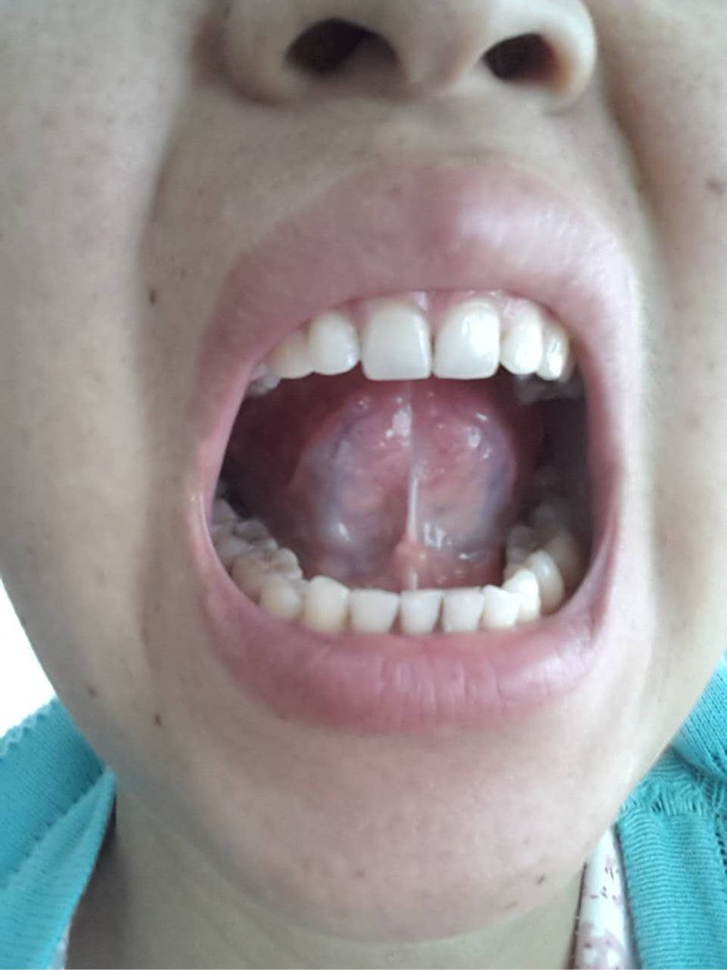 出仓一个月口腔问题!