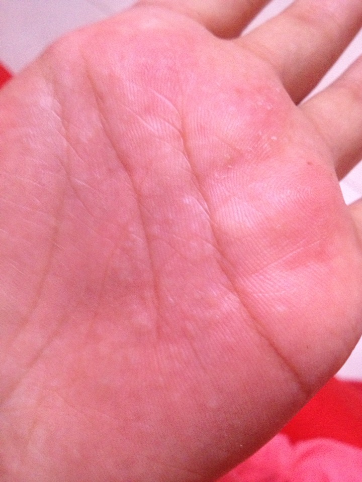 手掌起了好多小米粒的疙瘩十分痒有类似的吗