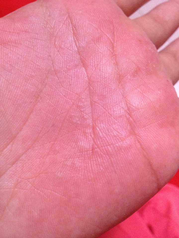 手掌起了好多小米粒的疙瘩十分痒有类似的吗