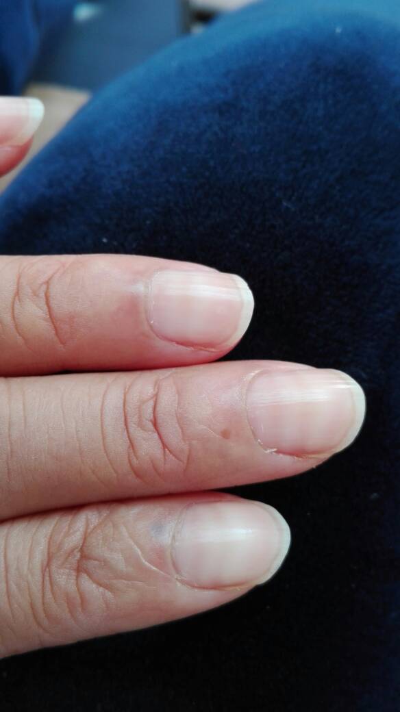 化疗后指甲出现横纹