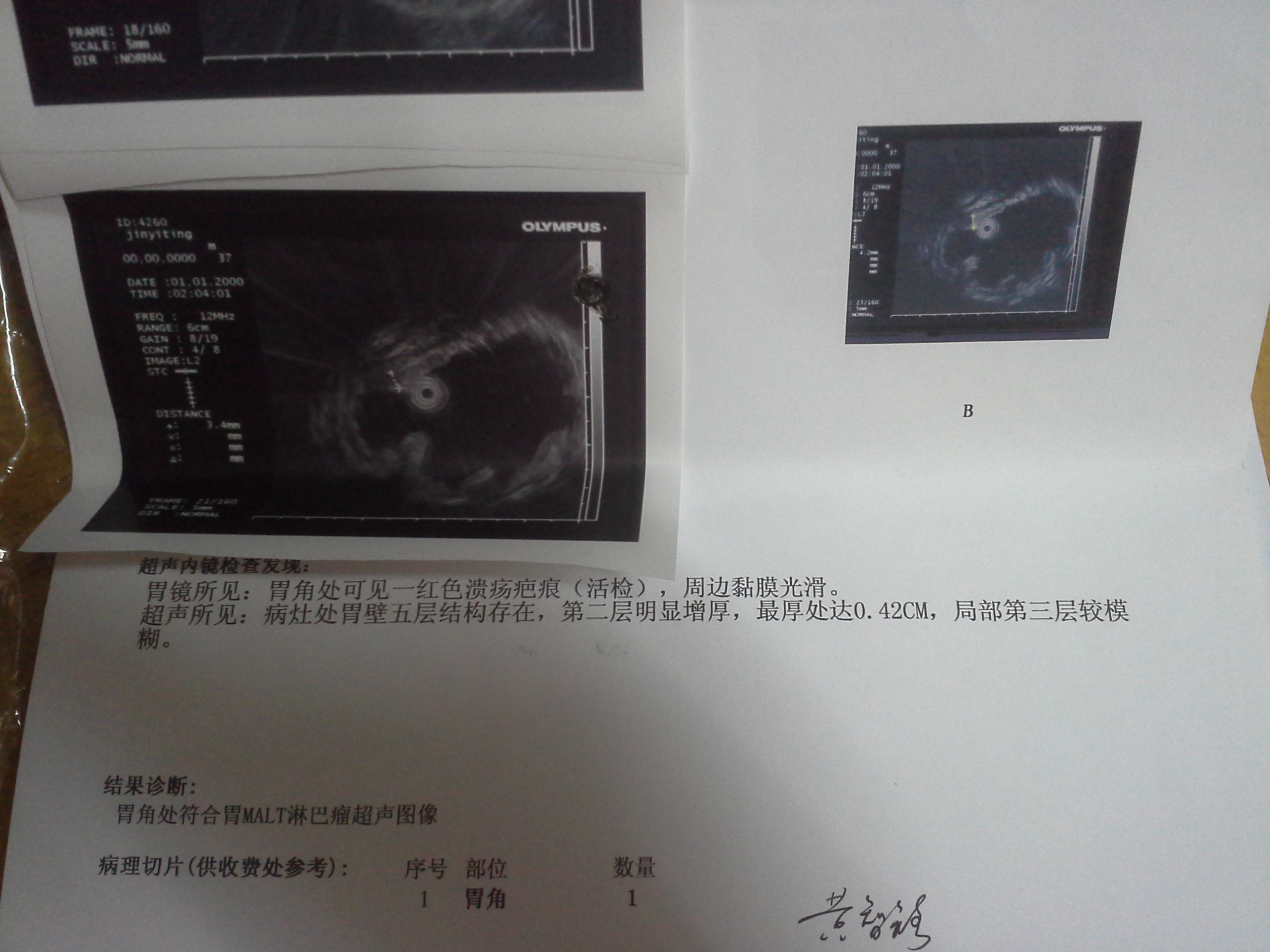 2014年8月28日第一次超声胃镜.jpg