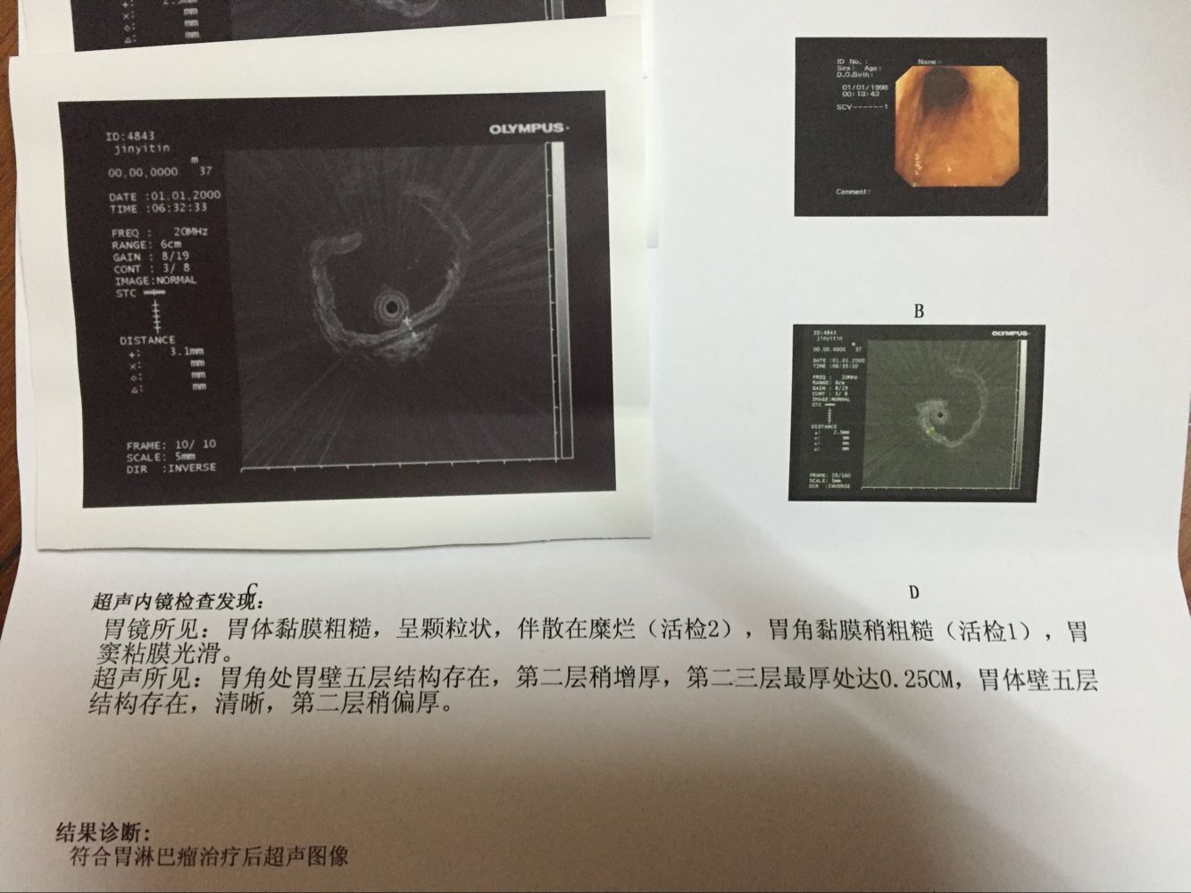 2016年2月18日第四次超声胃镜.jpg