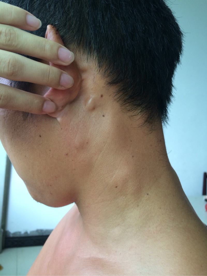 请大家帮忙分析到底是外周t细胞淋巴瘤还是误诊