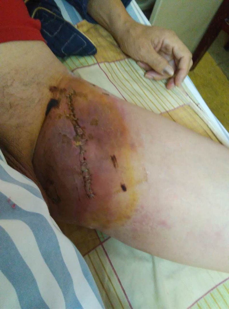 腹股沟活检后伤口一直不好红肿求支招