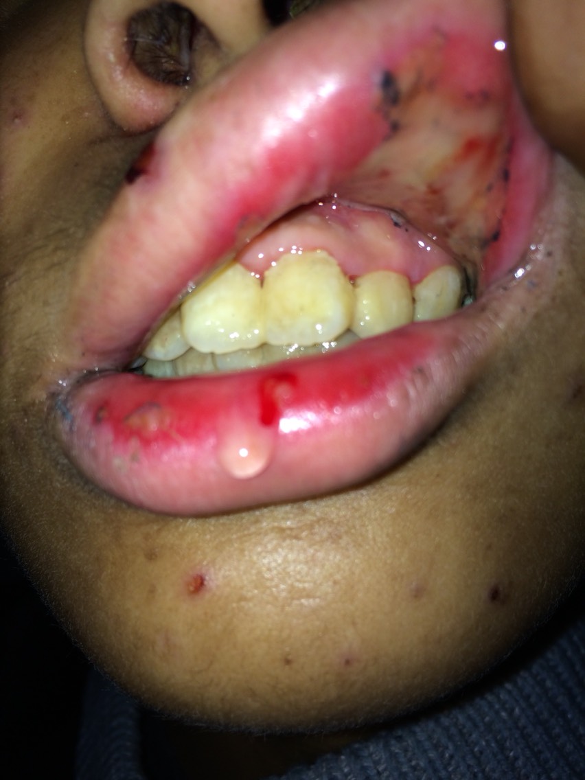 有没有用了化疗药甲氨蝶呤口腔溃疡我这么厉害的