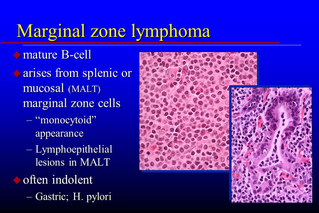 Marginal+zone+lymphoma.jpg