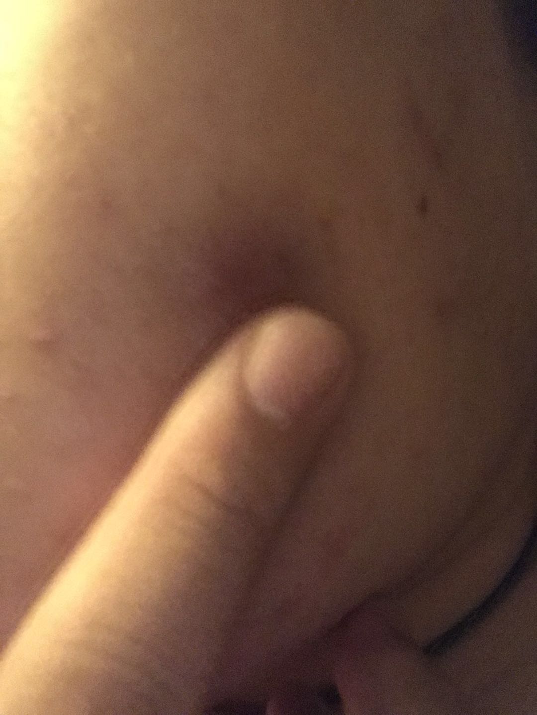 脸上的疖子