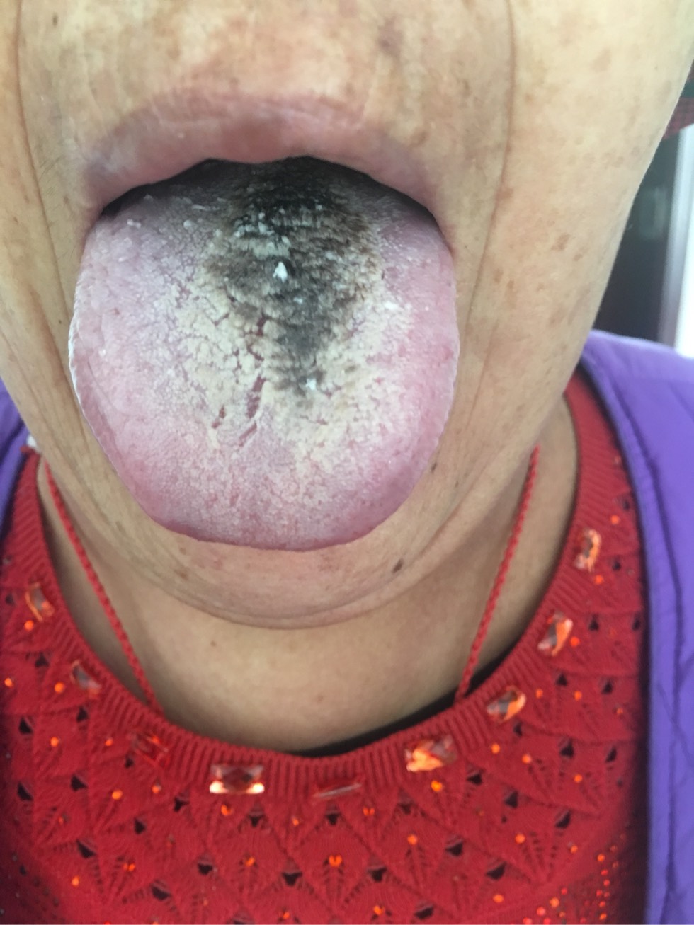 肝癌舌头图片黑紫图片