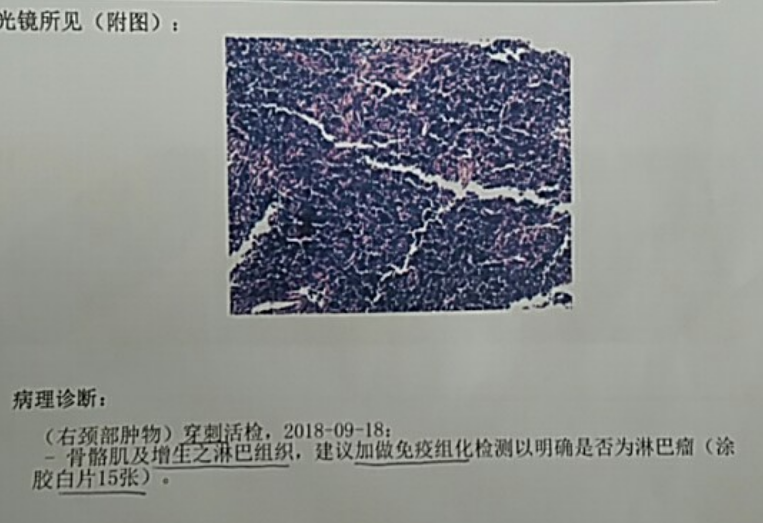穿刺病理