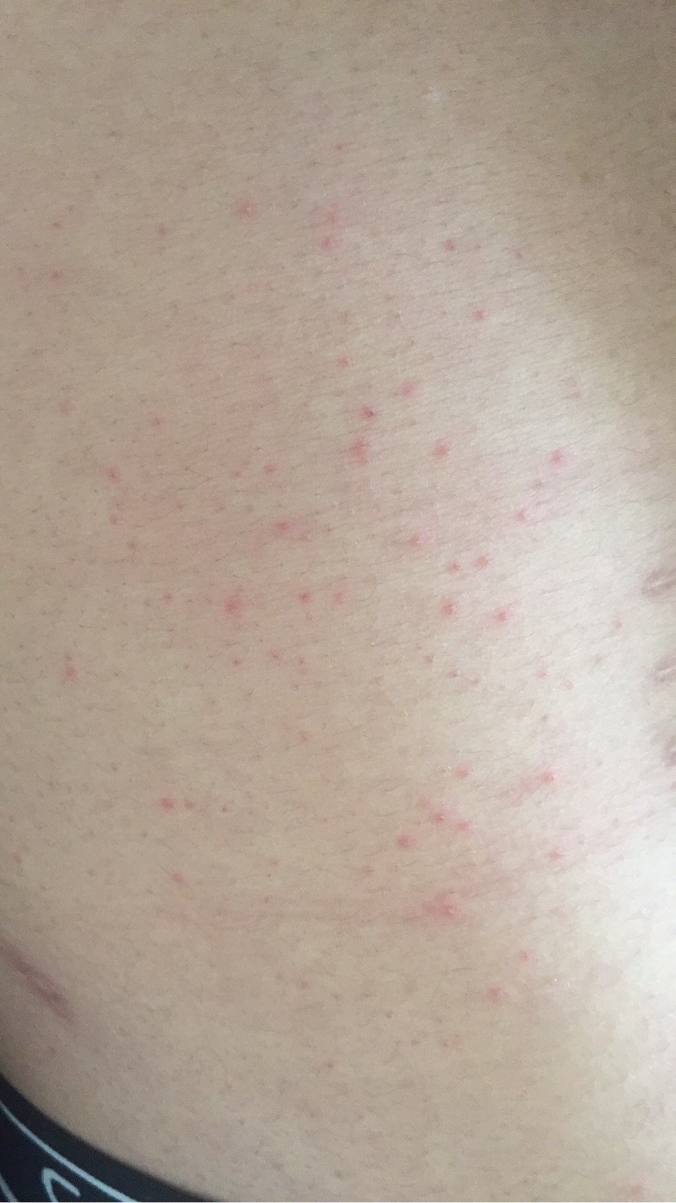 脸上和身上都是红色的疹子怎么办有图慎入