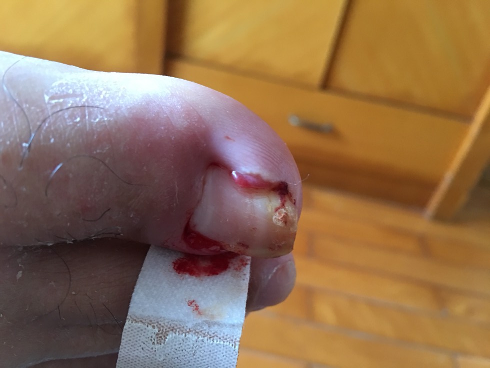 拇指脓血请教有什么办法吗