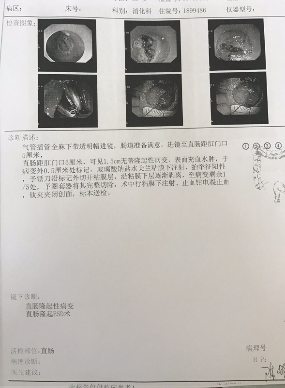 肠息肉手术记录