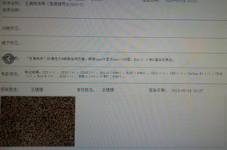 左扁桃体活检和免疫组化.jpg