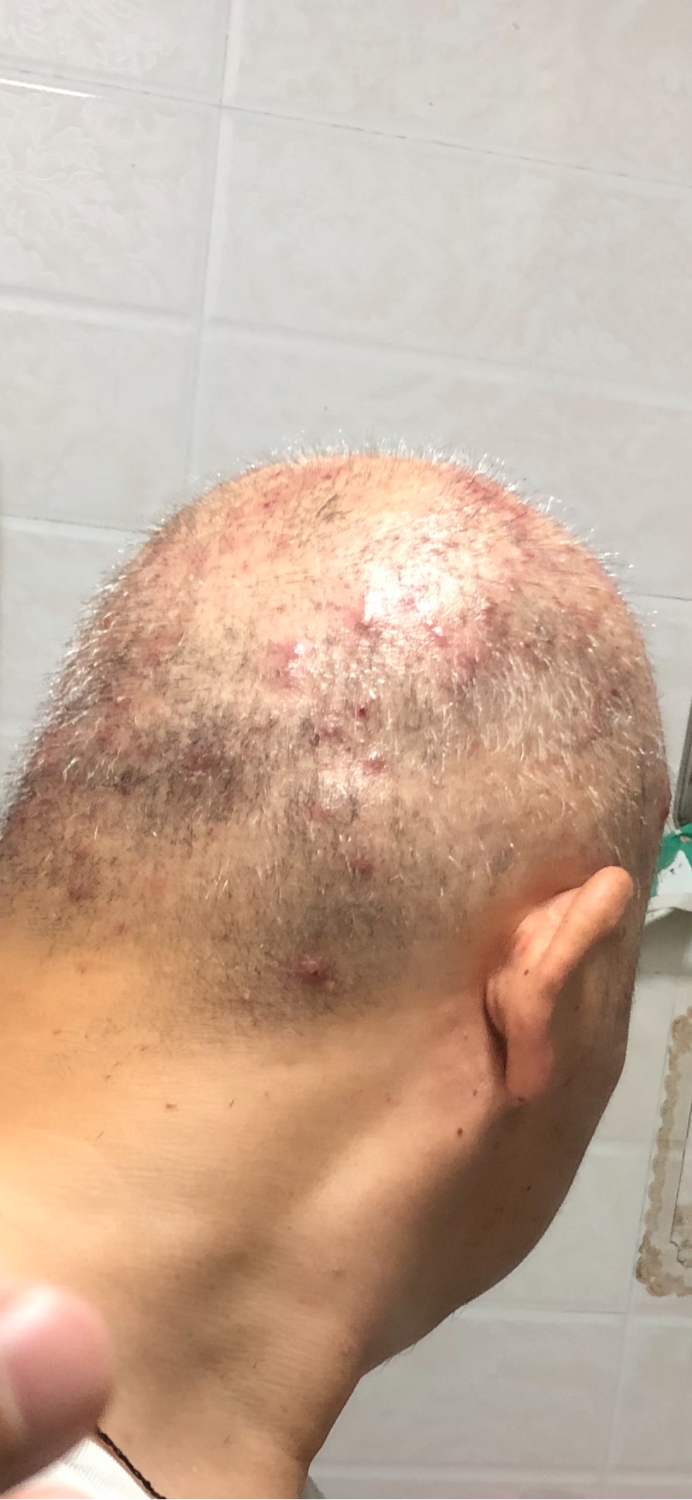 请教二疗后头皮上长红疙瘩