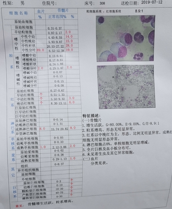 骨髓穿刺