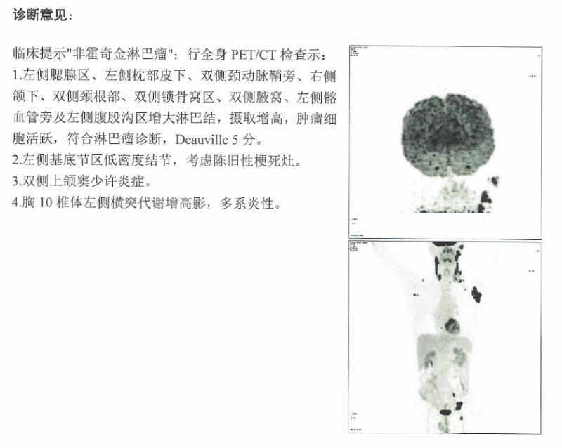 治疗前petct