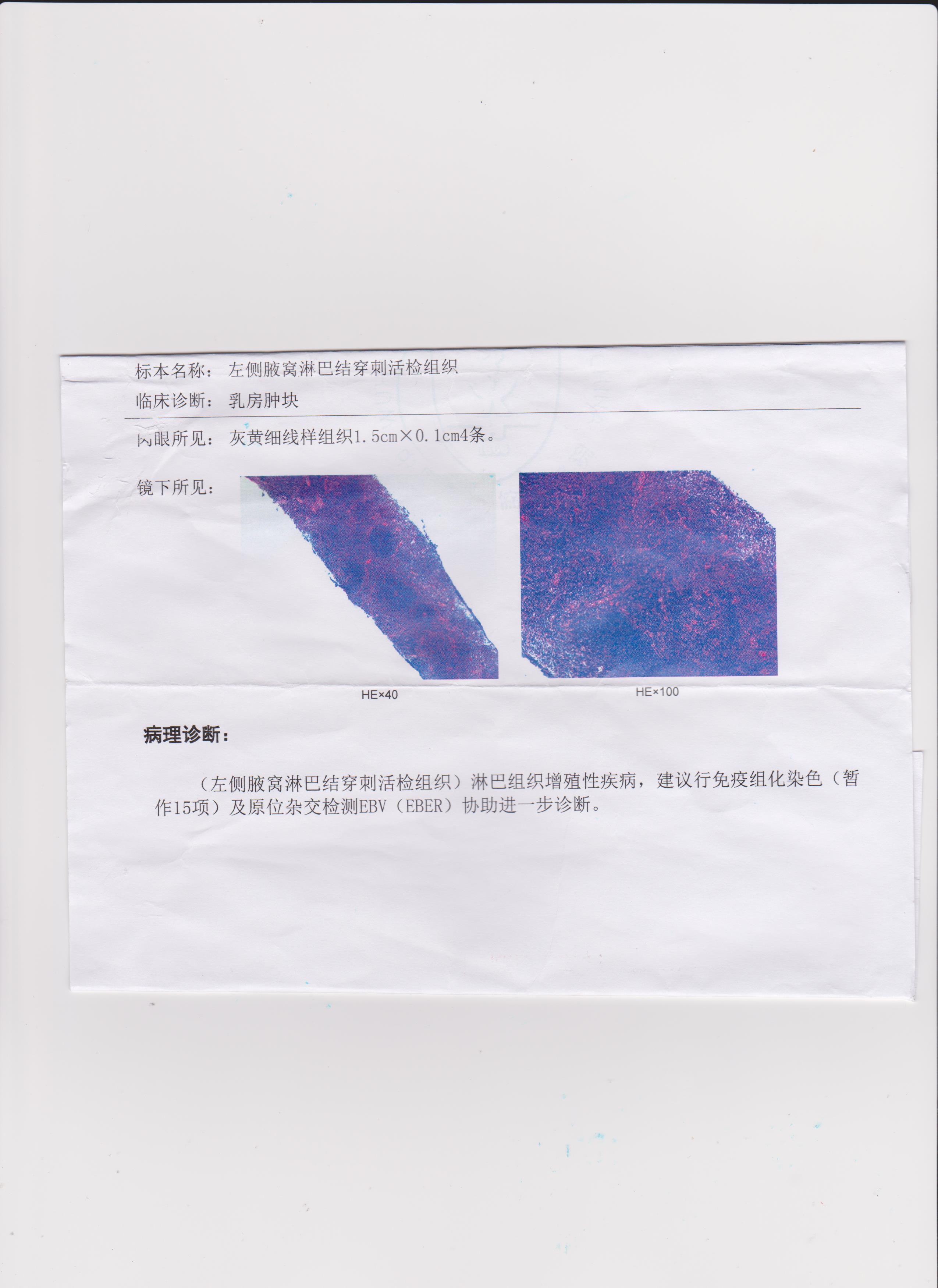 腋下粗针穿刺病理结果