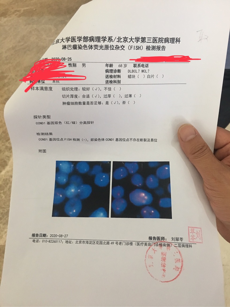 今天拿到了病理补充报告和fish请大神再给看看