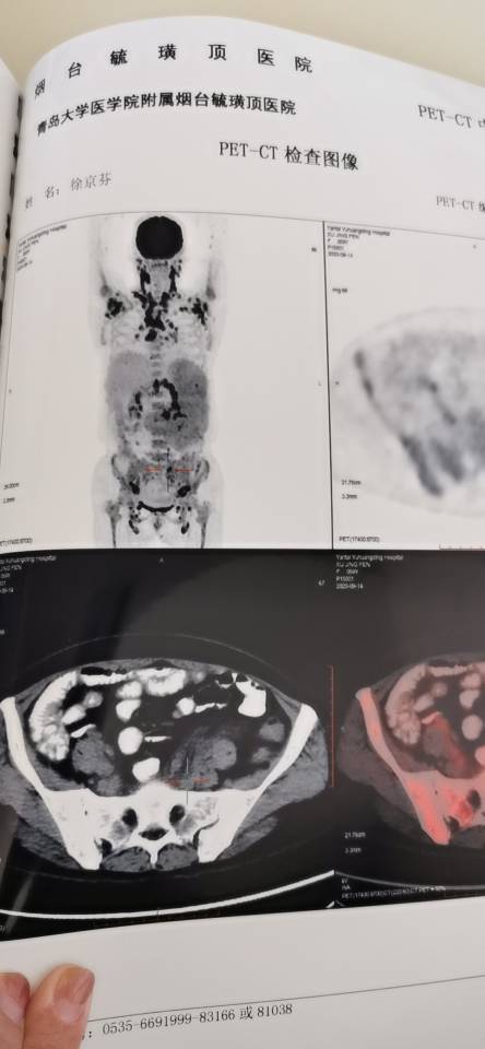 外周t一疗结束petct中评分2分是啥意思