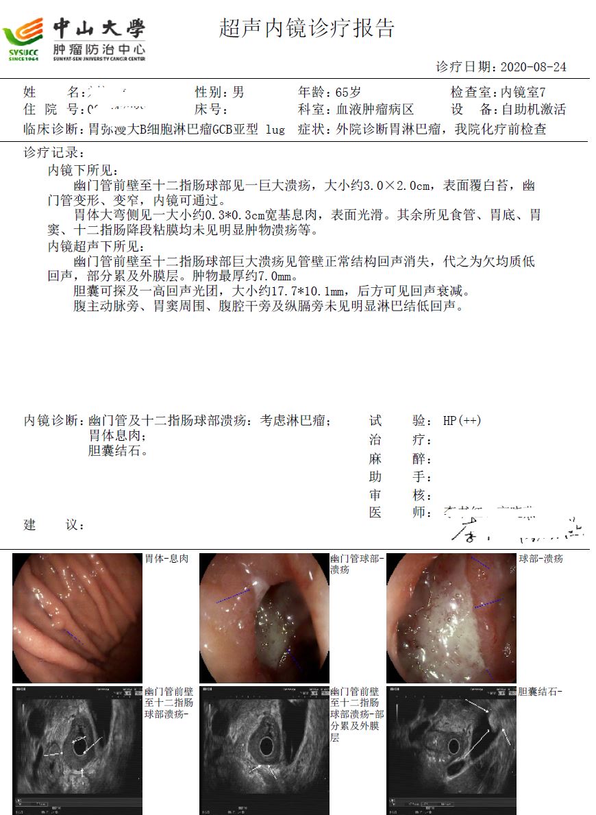 化疗2次胃超声