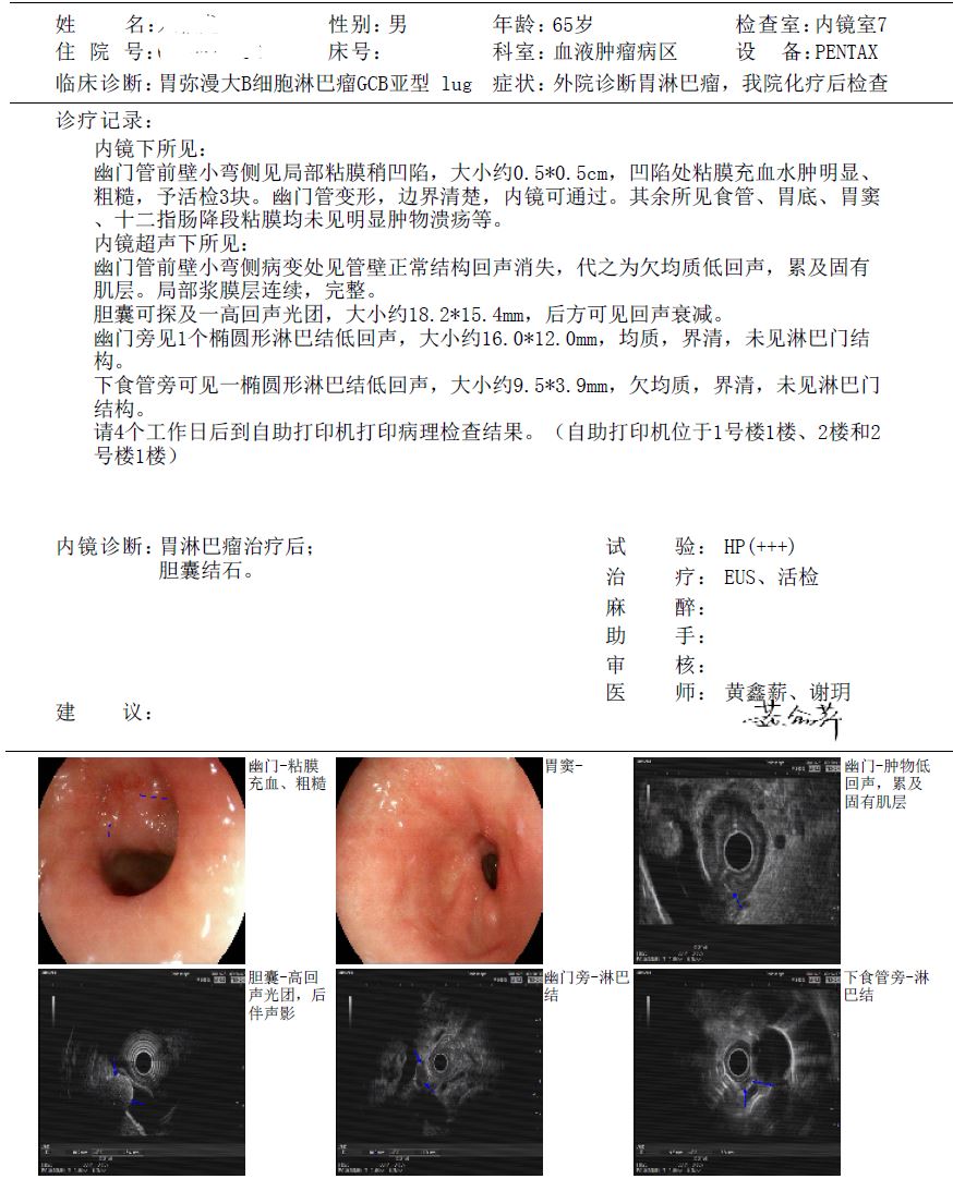 化疗6次后胃镜